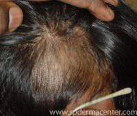Alopecia-After 2 months